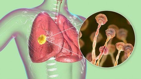 covid associated pulmonary aspergillosis 555