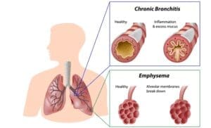 what is COPD