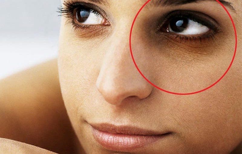 dark circles