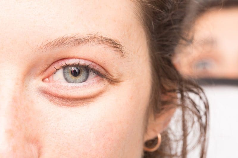 Bags Under Eyes 800x534 1